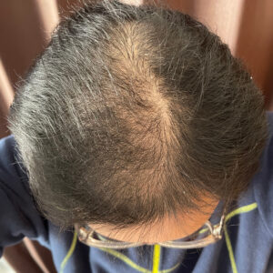 薄毛改善の検証実験開始より2ヶ月経過後　頭頂部状態　画像